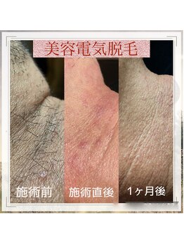 サロン ド ソレイユ(Salon.de.Soleil)/美容電気脱毛☆首ヒゲ