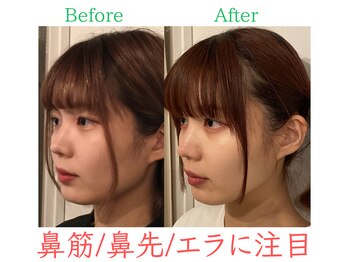 ラプリ 福岡博多店(Raplit)/隆鼻+輪郭・小顔矯正 美鼻/小顔