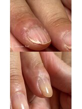 マイントゥ ネイル(mine too nail)/深いお悩みのトラブル爪も！