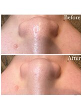 マドモアゼル 麻布十番/毛穴洗浄