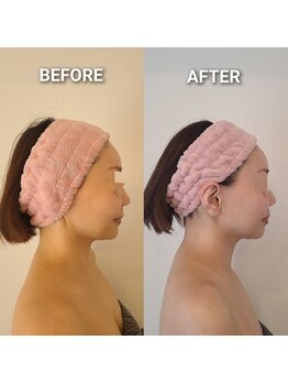 リンド(Lindo)/最強小顔+脂肪分解レモンボトル