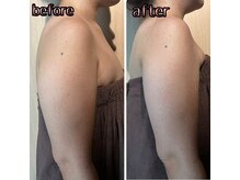 マーリエ(Malie)/【オールハンド】二の腕５回施術