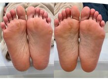 キラネイル アンド アイラッシュ by World Beauty(KIRA)/フット角質ケア