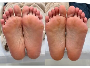 キラネイル アンド アイラッシュ by World Beauty(KIRA)/フット角質ケア