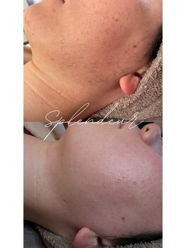 スプランドゥール(Splendeur)/レディース顔 ワックス+光脱毛