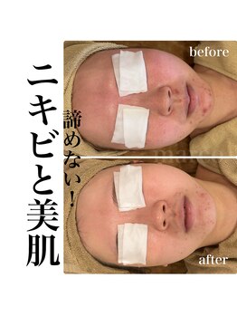 マルコ(marco)/ニキビケア　症例　途中経過