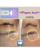 リーシャ(Reesha)/プラズマトリートメント