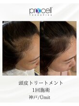 ユミト(Umit)/プロセルスカルプ