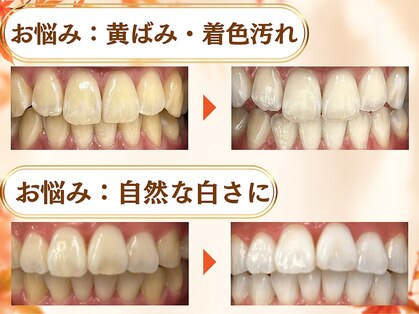 LBSホワイトニング 梅田店の写真