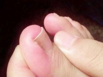 ラックス 千葉ニュータウン店(LAXX)の写真/「深爪が気になる…」「巻き爪を何とかしたい…」爪のお悩みは【LAXX】にお任せ☆健康的な美爪へと改善！