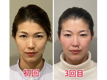 小顔22 ボルティ 赤坂支店(Bolty)/【面長の悩み】解消サロン