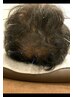 【育毛鍼】頭部・肩首鍼＋ヘッドスパ（ヘッドマッサージ）60分　9,900円