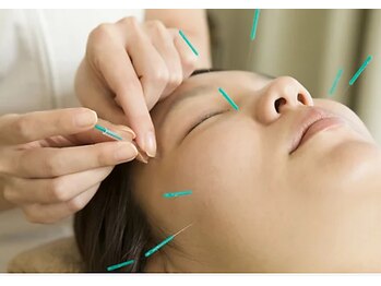 もんたわ鍼灸整骨院/美容鍼