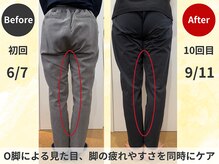 スロース鍼灸整体院(SLOTH鍼灸整体院)/О脚の改善例