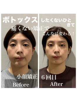 ニコ(NICO)/ビフォーアフター　６回目