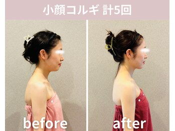 フェリシア(Felicia)/【小顔コルギ】計5回の結果