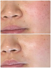 アデージョ(Adejio)/ララピール