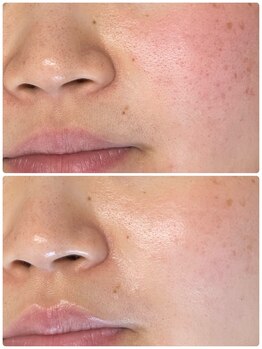 アデージョ(Adejio)/ララピール 20代お客様