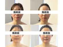 ビオルネ(VIE.ORNER)/小顔コルギ