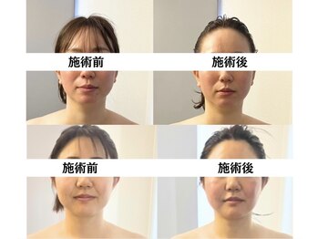 ビオルネ(VIE.ORNER)/小顔コルギ