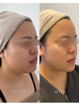 彌庵の写真/【インモード×LDM×次世代脂肪分解アンプル】美肌脂肪分解ケアで周囲の組織に負担をかけずアプローチ