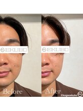 エクボ 立川店(EKUBO)/顔幅激変!!１度でここまで