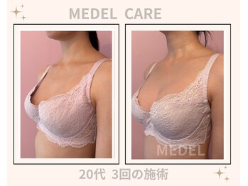 メデル 北千住店/バストアップ*育乳症例