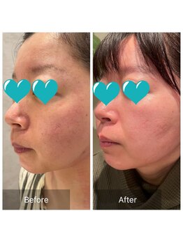 ルナスーリヤ 表参道店/艶やかな肌でエイジング小顔ケア