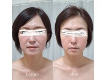 ネマウム(nemaum)/最強小顔♪脳美容＋フェイシャル