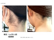 リネ(Rine)/before→after