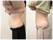 ゆうきや整体院/ぽっこりお腹解消！整体+キャビ