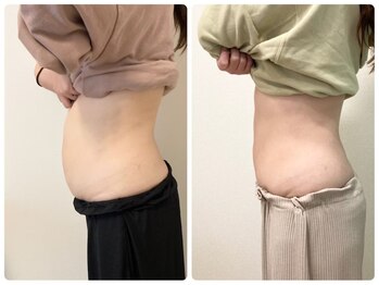 ゆうきや整体院/ぽっこりお腹解消!整体+キャビ