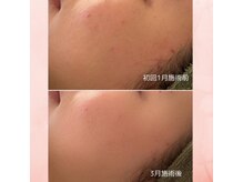 ククル(KUKULU)/ハーブ4回目♪（20代後半女性）