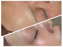 韓国肌管理ララピール!施術直後から韓国人のような艶肌になれる!