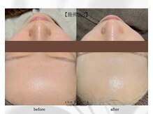 アン ビューティー(ann beauty)/施術2回【症例写真】20代