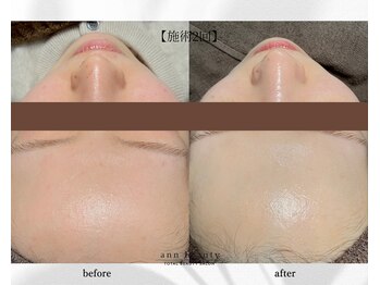 アン ビューティー(ann beauty)/施術2回【症例写真】20代