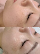 オンド(OND)/くすみ・シミケアで明るい肌へ