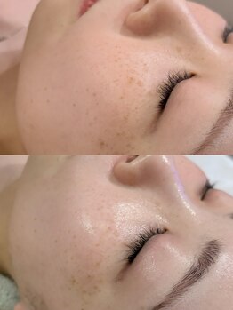 オンド(OND)/くすみ・シミケアで明るい肌へ