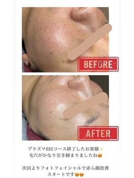 ハナ(HANA)の写真/プラズマケアで毛穴・シミ・シワ・くすみへアプローチ！透明感あふれる肌へ☆