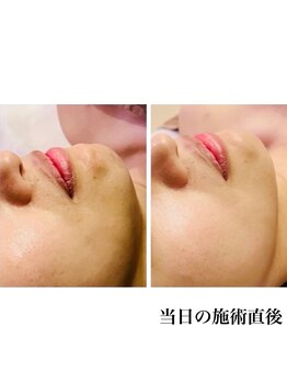 マヒナ(Mahina)の写真/【手技×マシン×エクソソーム】理想の小顔◆デコルテまで丁寧にほぐしてスッキリ美しいフェイスラインに!!