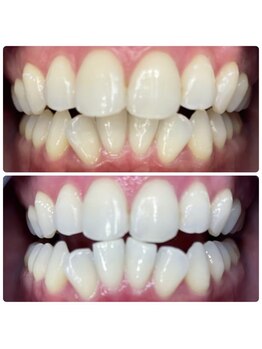 ラブホワイトニング 恵比寿店(LOVEホワイトニング)/【初回限定】2回照射¥980