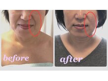 ゆずり葉/５０代気になるほうれい線にも