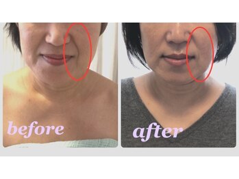 ゆずり葉/５０代気になるほうれい線にも