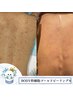 実は、意外と見られている？！背中のニキビ・シミ退治