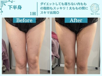 フローフシ∞/【痩身】下半身・お尻の脂肪撃退