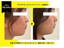 イエス マイサロン(yes My Salon)/プラズマリフトアップ症例