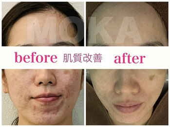 モカ(MOKA)/肌質改善プログラム