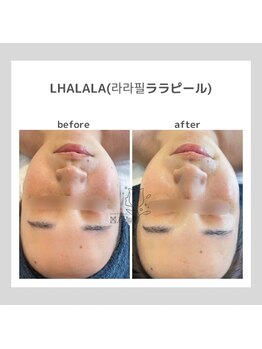 韓国肌管理室pom.haneul【ポムハヌル】LDM/インモード/ララピール/プラピール福岡天神/韓国肌管理室