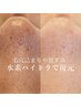 【黒ずみ・角栓・ざらつき】毛穴洗浄＋ピーリング ￥22,000→￥8,800
