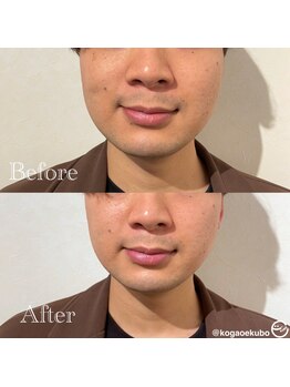 エクボ 立川店(EKUBO)/口元すっきりシャープな印象に☆